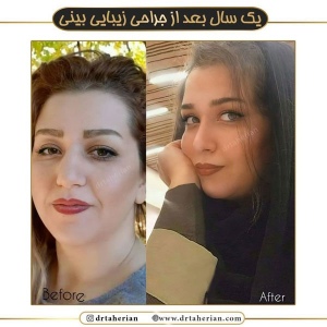 جراحی-بینی-536
