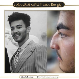 جراحی-بینی-538