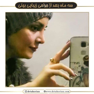 جراحی-بینی-539