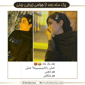 جراحی-بینی-540
