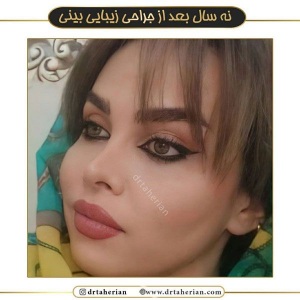 جراحی-بینی-543