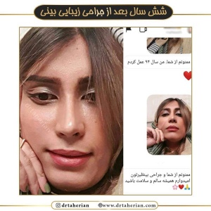 جراحی-بینی-544