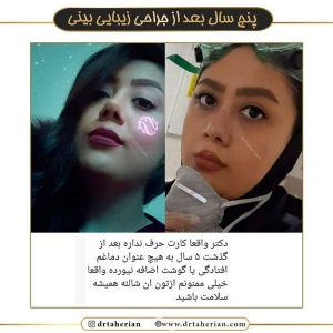 جراحی-بینی-545