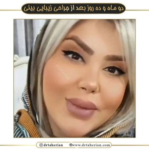 جراحی-بینی-546