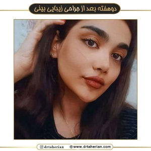جراحی-بینی-553