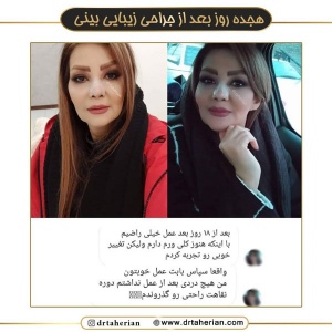 جراحی-بینی-554