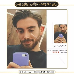 جراحی-بینی-558