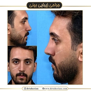جراحی-بینی-559