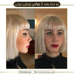 جراحی-بینی-561