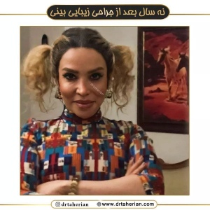 جراحی-بینی-564