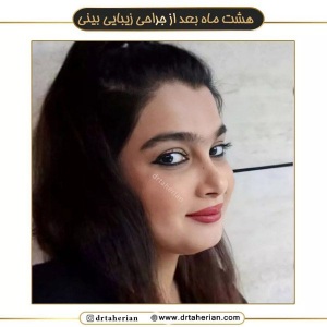جراحی-بینی-566