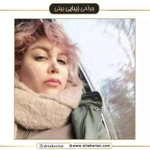 جراحی-بینی-571