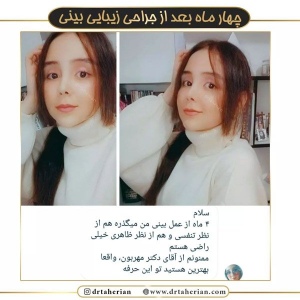 جراحی-بینی-572