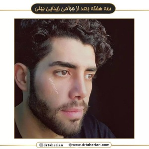 جراحی-بینی-573