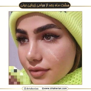 جراحی-بینی-574