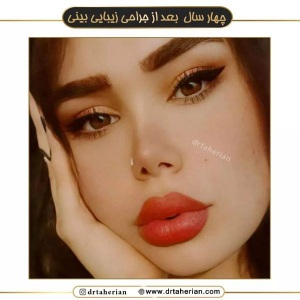 جراحی-بینی-577