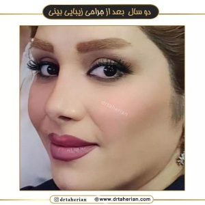 جراحی-بینی-578