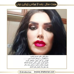 جراحی-بینی-579