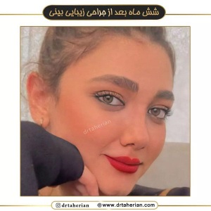 جراحی-بینی-583