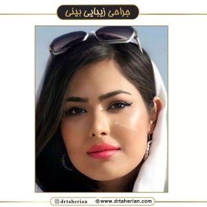 جراحی-بینی-586