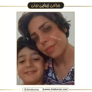 جراحی-بینی-587