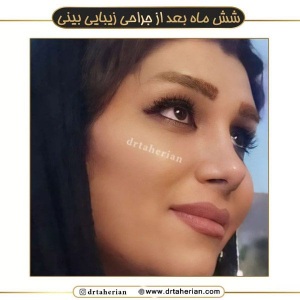 جراحی-بینی-588
