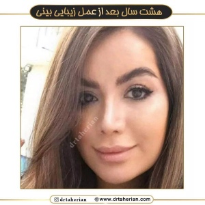 جراحی-بینی-591