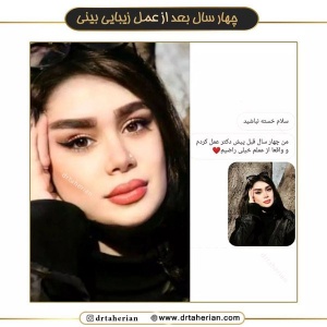 جراحی-بینی-592
