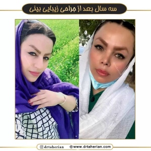 جراحی-بینی-593