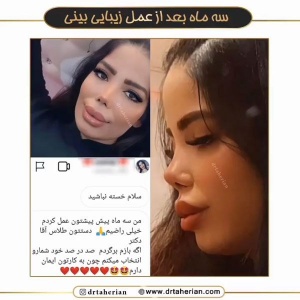 جراحی-بینی-594