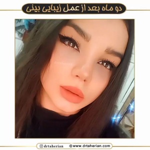 جراحی-بینی-596