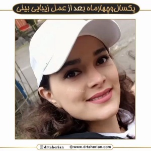 جراحی-بینی-598
