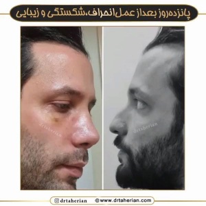 جراحی-بینی-599