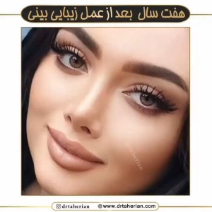 جراحی-بینی-603