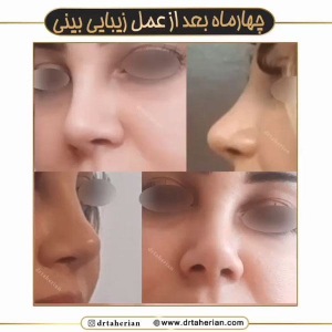 جراحی-بینی-604