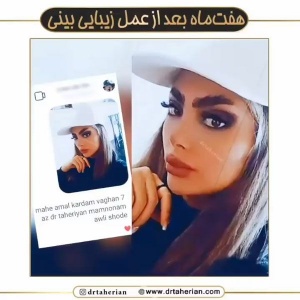 جراحی-بینی-605
