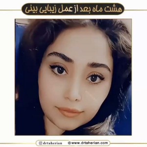 جراحی-بینی-609