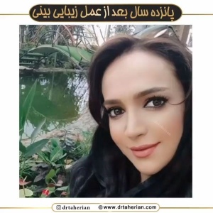 جراحی-بینی-611