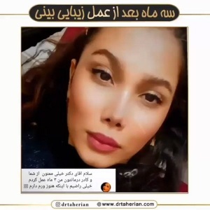 جراحی-بینی-613