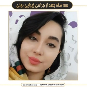 جراحی-بینی-625