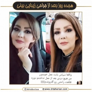 جراحی-بینی-627