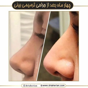 جراحی-بینی-629