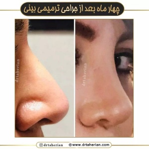 جراحی-بینی-630