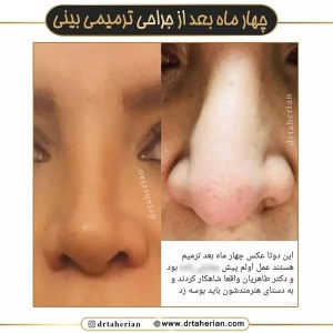 جراحی-بینی-631