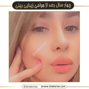 جراحی-بینی-633