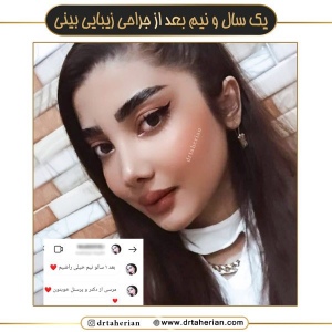 جراحی-بینی-636