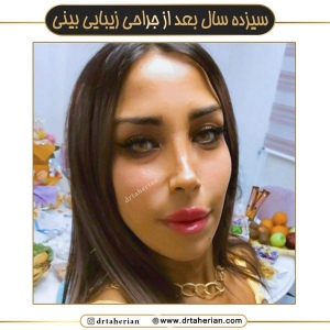 جراحی-بینی-638