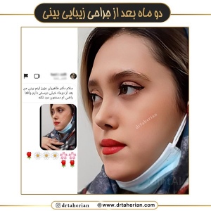 جراحی-بینی-639