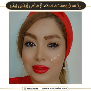 جراحی-بینی-640