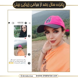 جراحی-بینی-643
